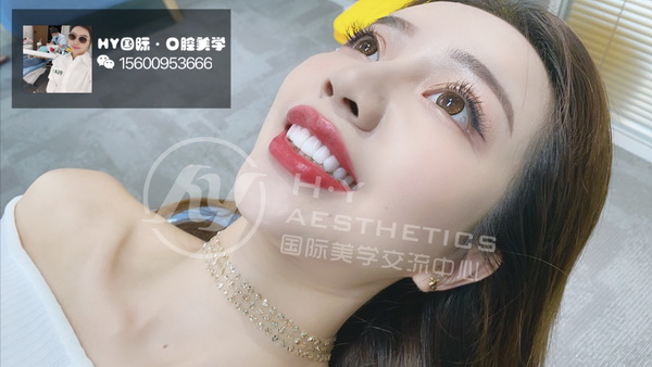 广州瓷贴面美牙培训