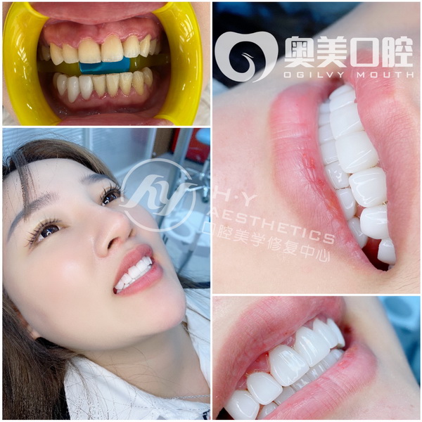 广州冰瓷美牙培训