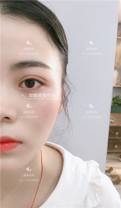韩国me双眼皮技术培训 