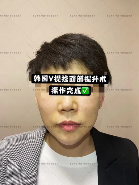 韩国V提拉术