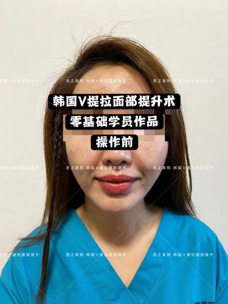 韩国V提拉术