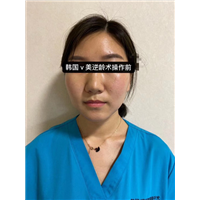 韩国V美减龄术多少钱