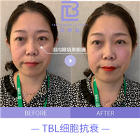 tbl抗衰