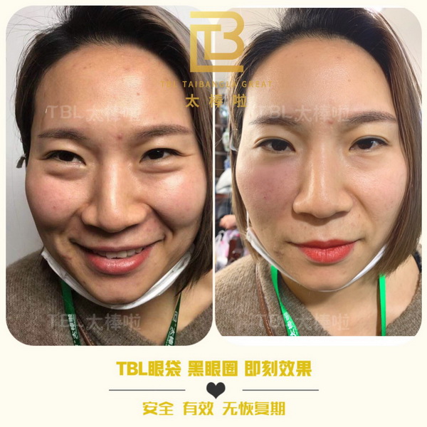 tbl代理