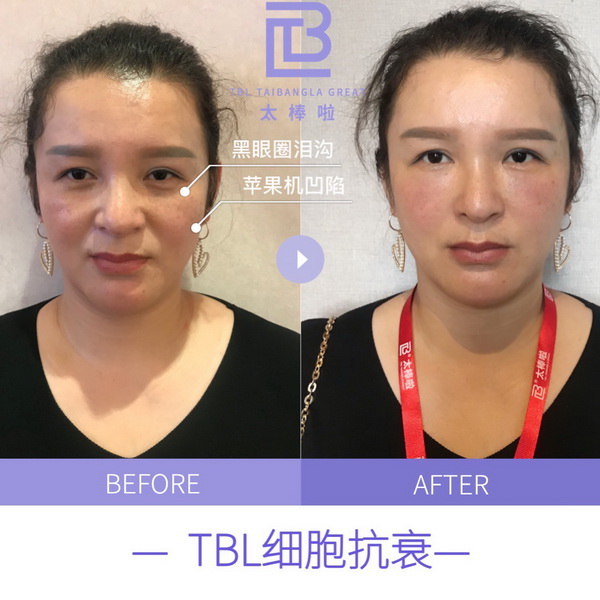 tbl抗衰