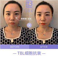 tbl抗衰