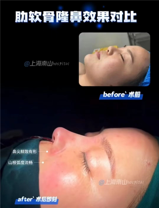 上海南山肋软骨隆鼻