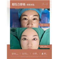 上海南山整形眼综合案例