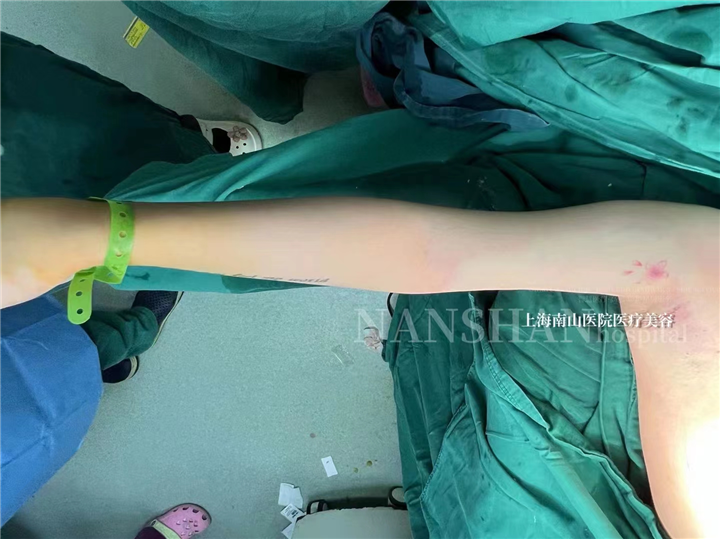 上海手臂环吸整形