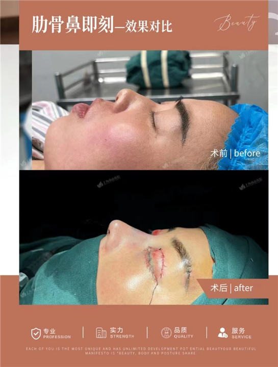 上海南山整形肋骨鼻综合术后