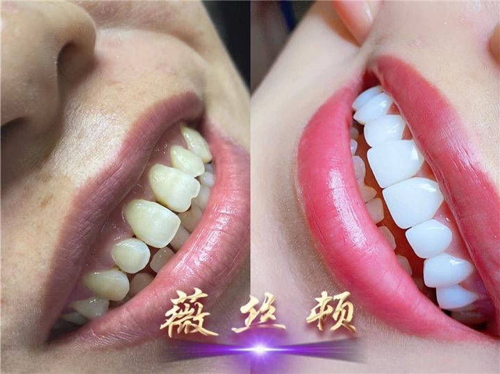 正规冷光美白牙齿培训