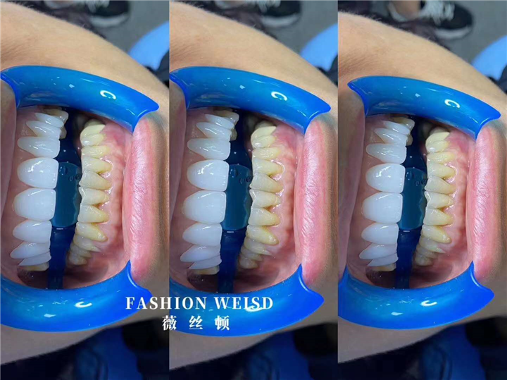 广州牙齿美白培训