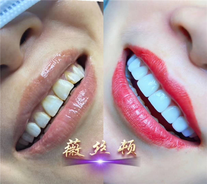 专业树脂贴片美牙培训