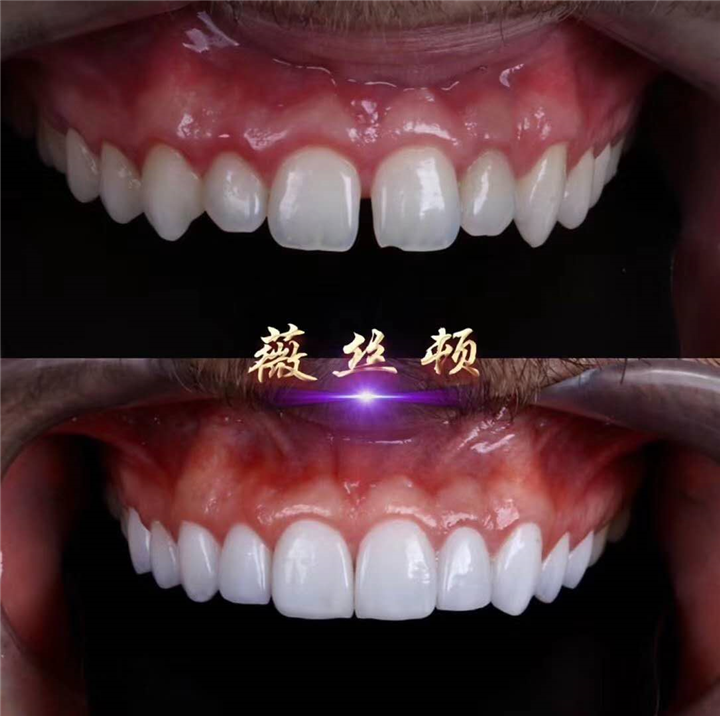 广州牙齿美白培训