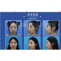章建林正颌手术