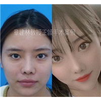 章建林正颌手术