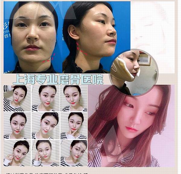 朴光哲磨骨怎么样