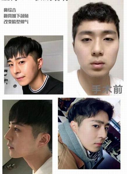 朴光哲磨骨怎么样