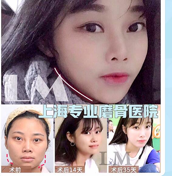 朴光哲磨骨怎么样