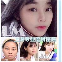 朴光哲磨骨怎么样