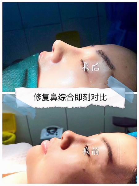 综合鼻修复