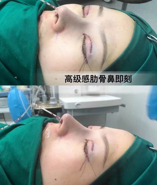 鼻综合