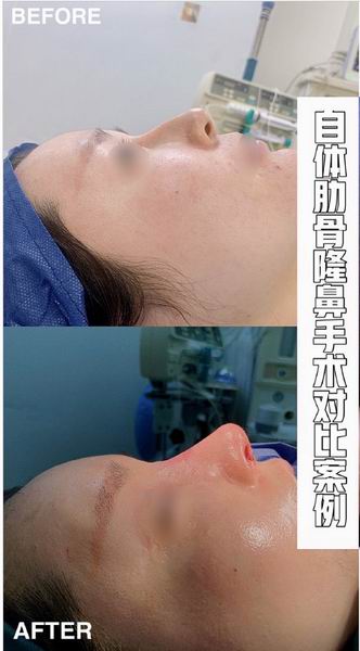 鼻综合