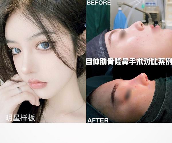 鼻综合