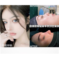 鼻综合