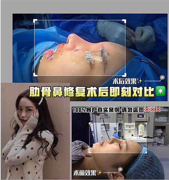 综合鼻修复