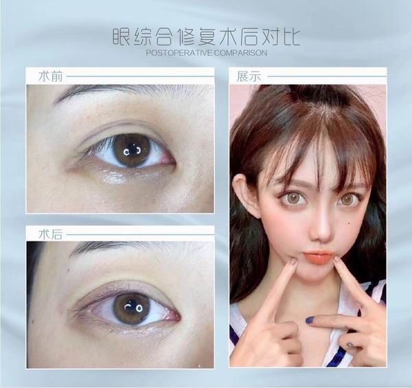 眼综合修复