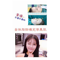 面部脂肪填充