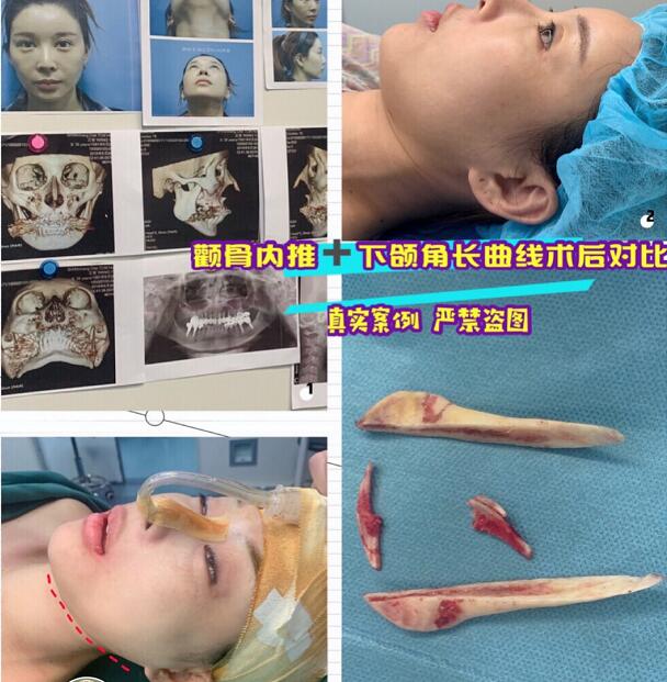 金一秀磨骨
