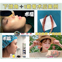 磨骨专家金一秀