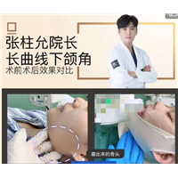 张柱允磨骨专家