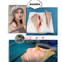 上海磨骨整形专家