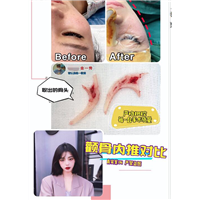 磨骨整形专家