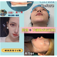 磨骨整形专家