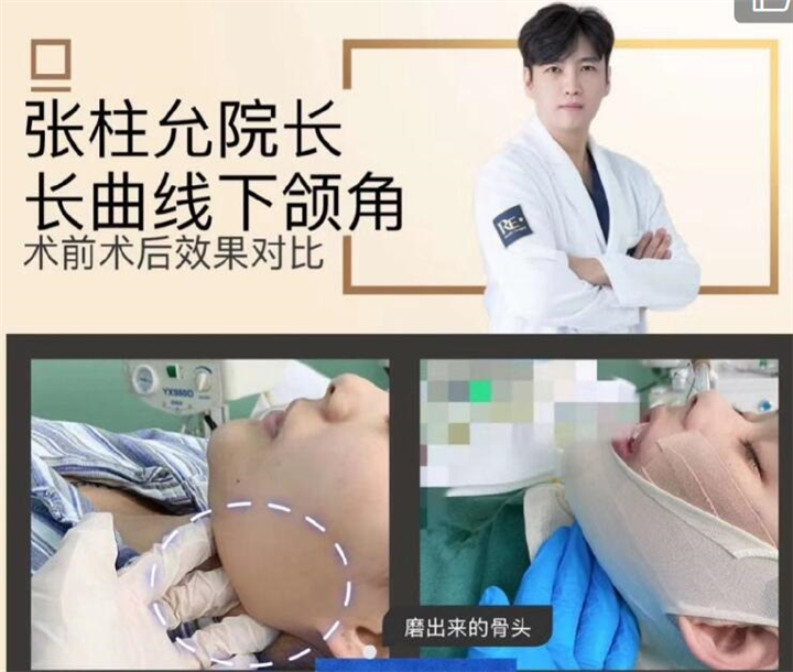 张柱允磨骨专家