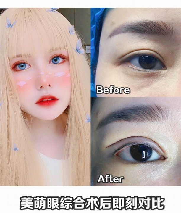 南昌双眼皮整形