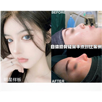 南昌鼻综合整形