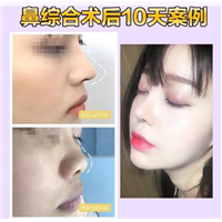 南昌鼻综合整形