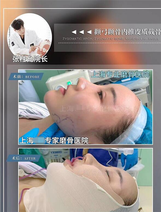 张柱允磨骨专家