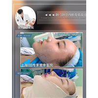 张柱允磨骨专家