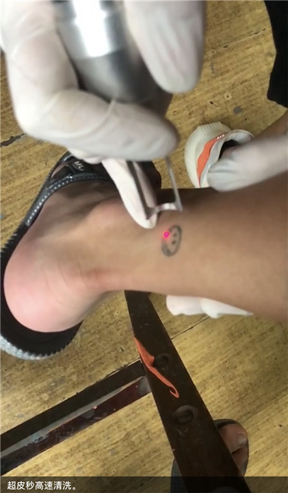 赣州洗纹身服务 