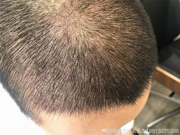 佘晓龙毛发移植专家 