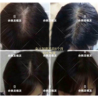 厦门毛发移植专家