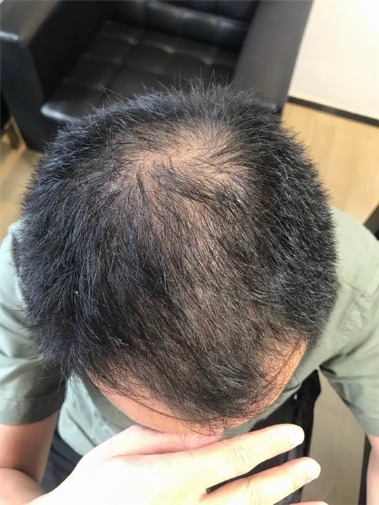 佘晓龙植发医生 