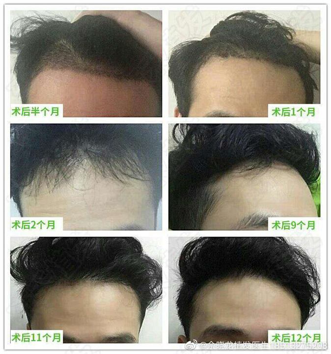 佘晓龙毛发移植专家 