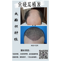 厦门植发专家